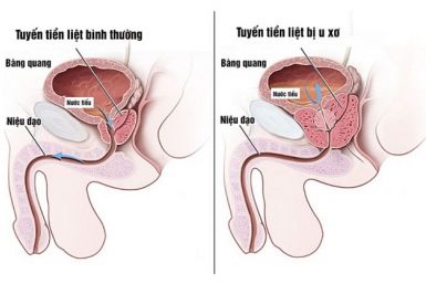 tieu-gap-tieu-son-tieu-nhieu-lan-nguyen-nhan-cach-khac-phuc